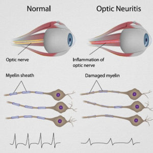 OpticNeuritis